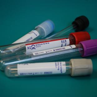 JAMANeurology_plasmaBAmyloid